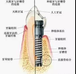 种植牙优势和趋势